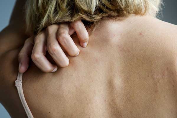 Can Fibromyalgia Cause Skin Rashes